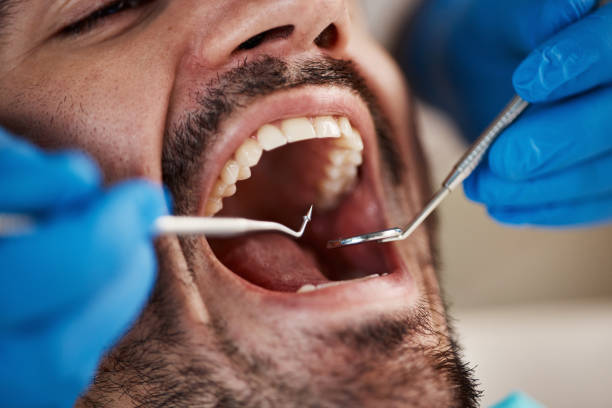 Best Emergency Wisdom Tooth Extraction in Buffalo, MO